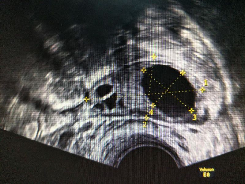  Transvaginal USB Ultrasound Scanner result