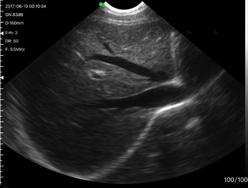 Resultaten van draagbare ultrasone scanner