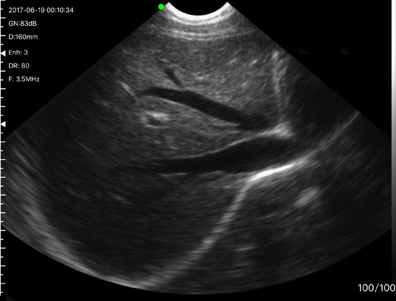 Mga Resulta ng Scanner ng Handheld Ultrasound