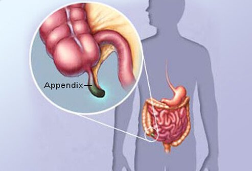 ano ang sakit na appendix - Sonia Vaughan