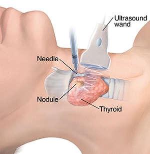 the needle test