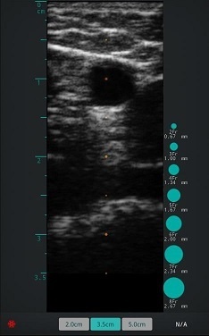 Basilic Vein Clinic Ultrasound Image
