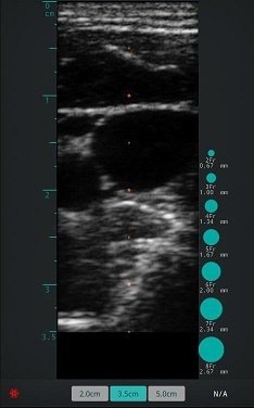 Jugular Vein Ultrasound Image