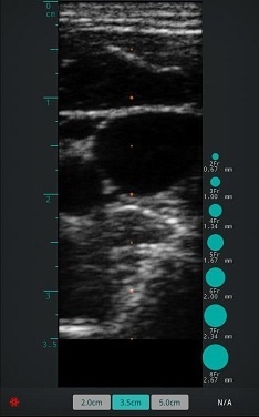 Imatge d'ultrasò de la vena jugular