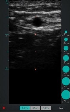 Radial Artary Clinic Ultrasound Image