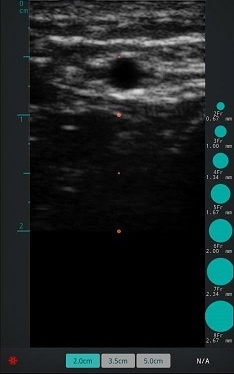 Imagen de ultrasonido de la clínica arterial radial