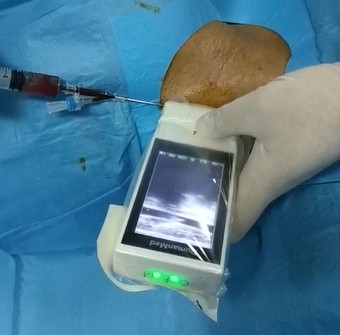 Isterilisasyon sa pagpapatakbo ng Screen Linear Ultrasound Scanner ng built-in na Screen