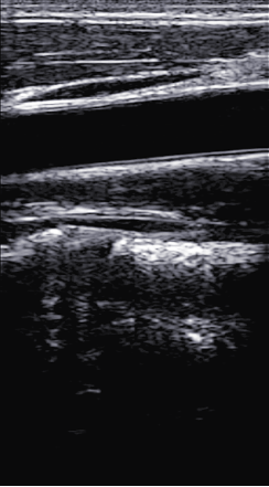 Imaging dell'arteria carotide