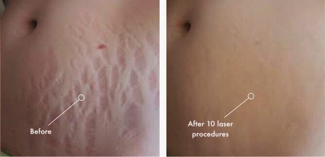 Diode Laser System SIFLASER-2.1 | Surgery Diode Laser Machine